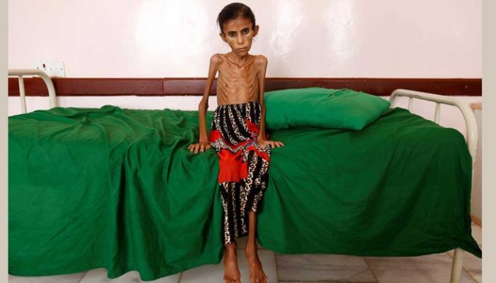 Fatima Ibrahim Hadi, 12, who is malnourished and weighs just 10 kg, sits on a bed at a clinic in Aslam, in the northwestern province of Hajjah, Yemen, February 17, 2019. REUTERS