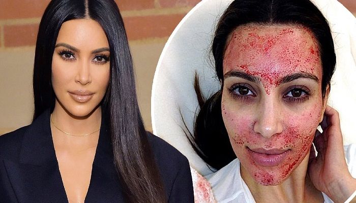 Kim Kardashian Sues Doctor Over 'Vampire Facial'
