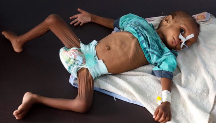 A malnourished child receives treatment at a malnutrition centre in Yemen's third city of Taez, on July 3, 2021. || AFP Photo: Collected