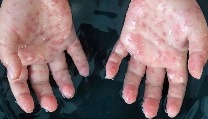 A hand of a man infected with the monkeypox virus || Photo: Collected 