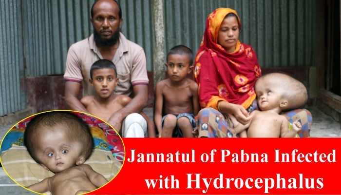 Advanced Treatment Needed to Save the Young Child Jannatul