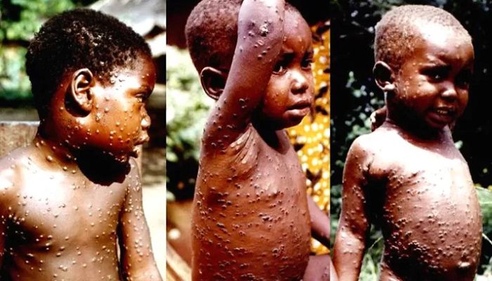 Monkeypox is a rare disease that is related to but less severe than smallpox || Photo: Collected 