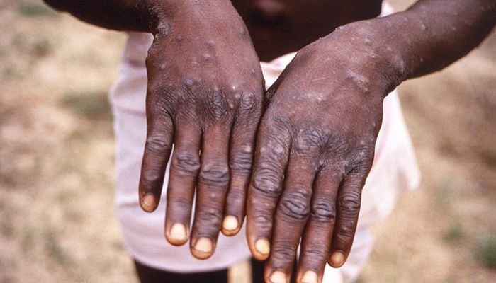WHO: Outbreaks of Diseases Such As Monkeypox Becoming More Frequent  