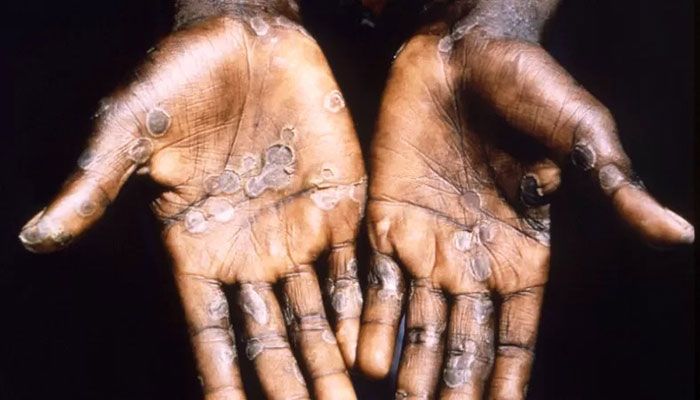 India Confirms 1st Monkeypox Case 