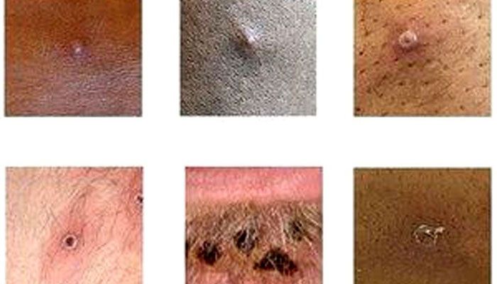 UK Monkeypox Symptoms Different to Prior Outbreaks: Study   
