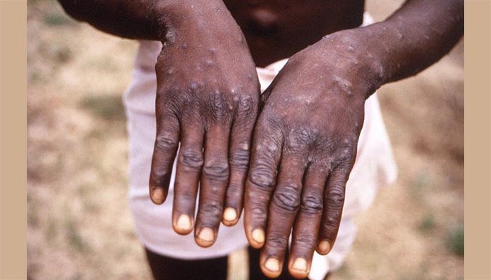 China Records First Monkeypox Case 