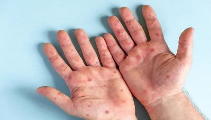 Monkeypox Mostly Spreads before Symptoms Appear, Study Suggests