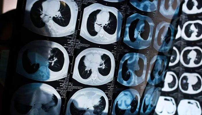 New AI Model Can Accurately Diagnose Cancer: Study 