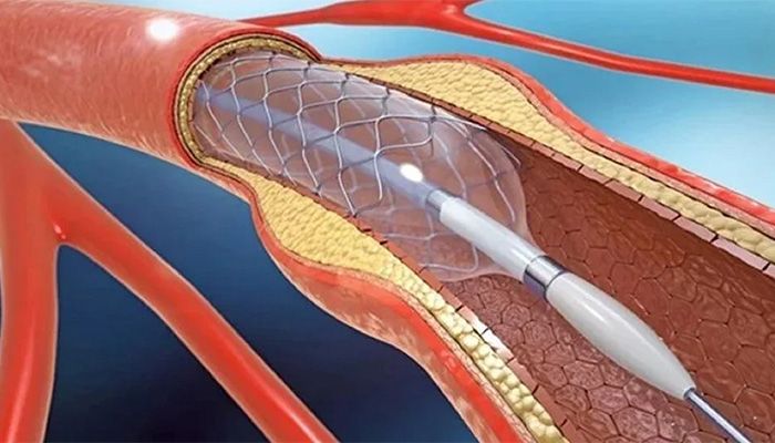 Remote robotic stent placement surgery || Representational Image